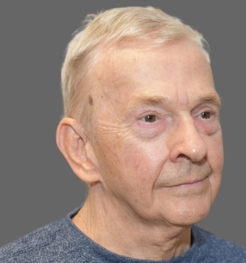 Facelift Before & After Gallery - Patient 461799 - Image 4