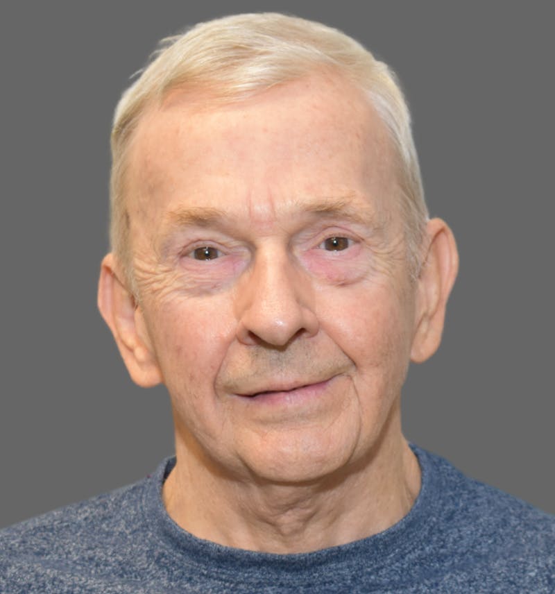 Facelift Before & After Gallery - Patient 461799 - Image 2