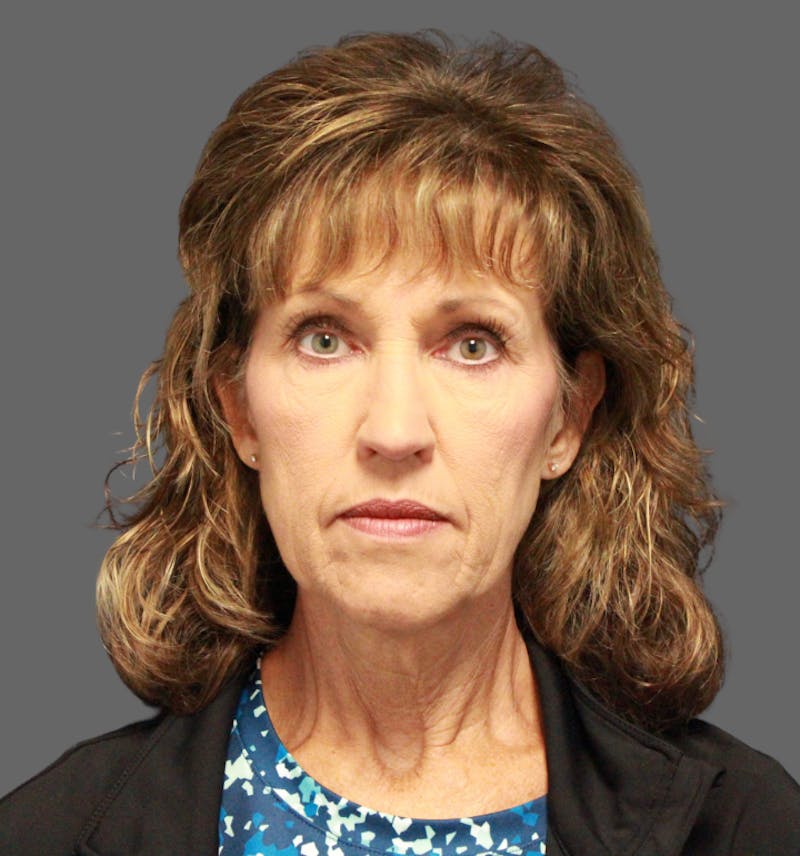 Facelift Before & After Gallery - Patient 386713 - Image 1