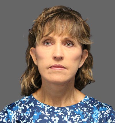 Facelift Before & After Gallery - Patient 386713 - Image 2