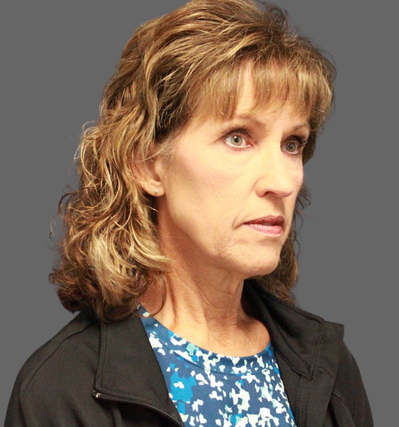 Facelift Before & After Gallery - Patient 386713 - Image 3