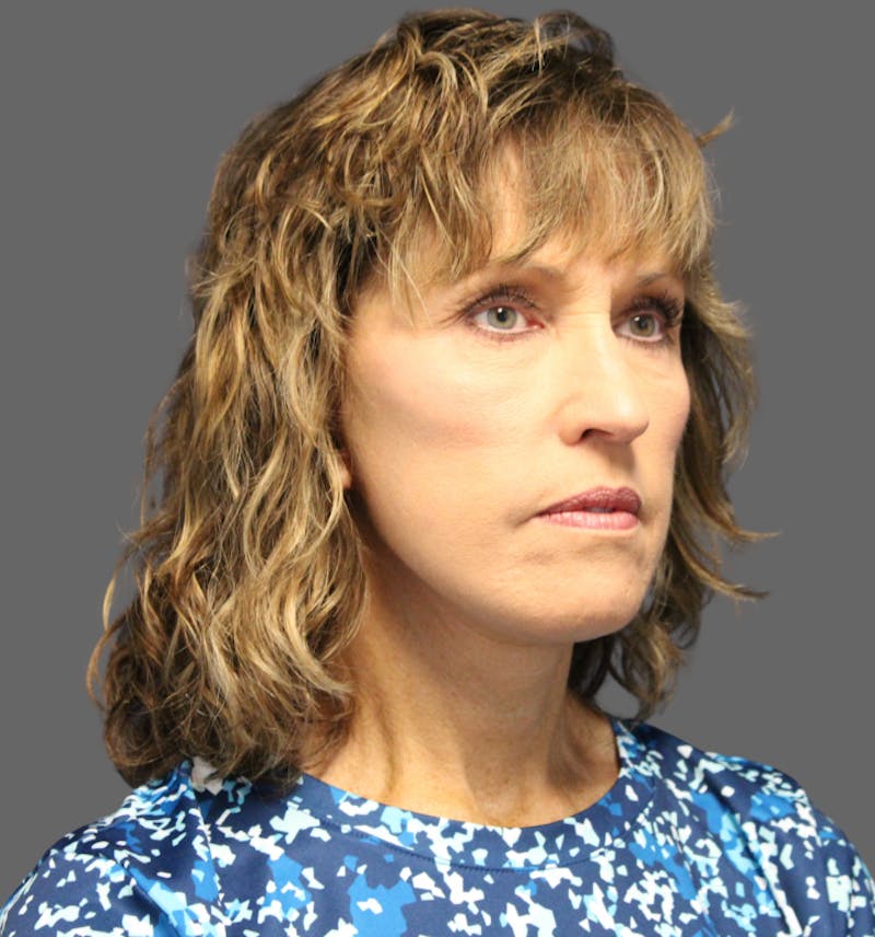 Facelift Before & After Gallery - Patient 386713 - Image 4