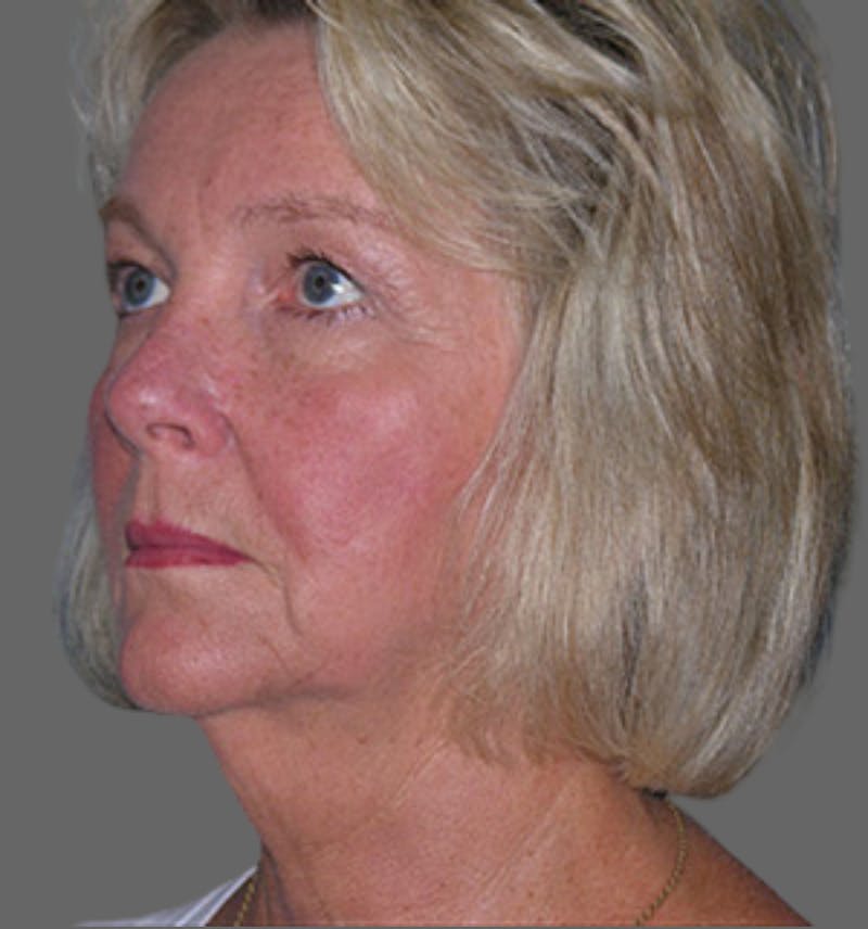 Facelift Before & After Gallery - Patient 122054790 - Image 3