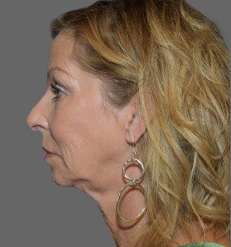 Facelift Before & After Gallery - Patient 122054789 - Image 3