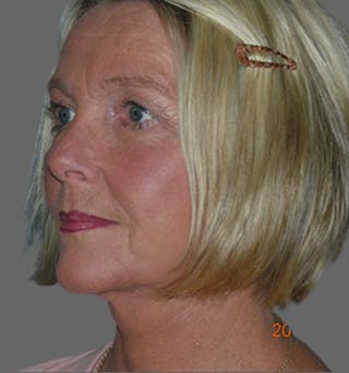 Facelift Before & After Gallery - Patient 122054790 - Image 4