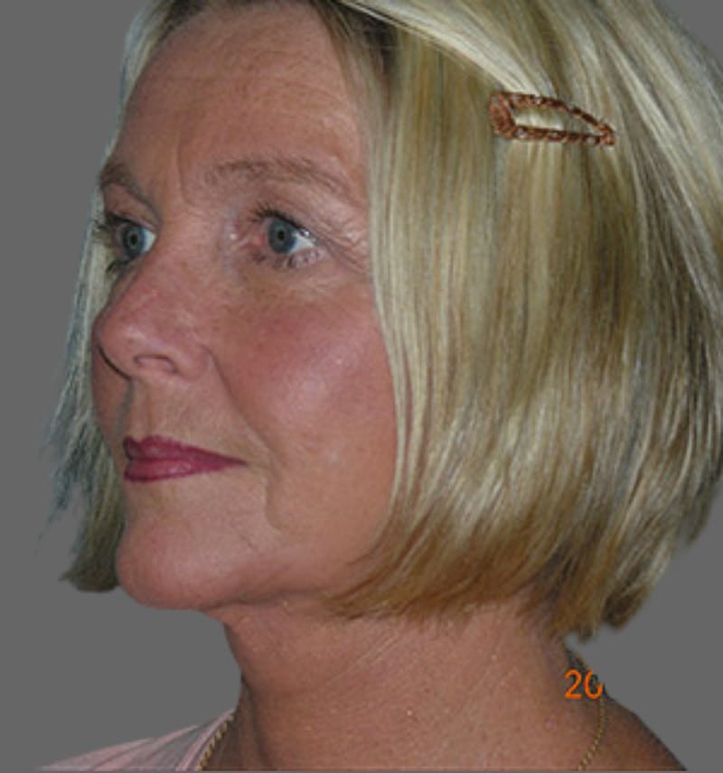 Facelift Before & After Gallery - Patient 122054790 - Image 4