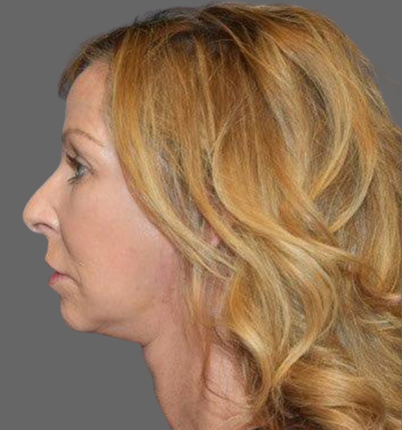 Facelift Before & After Gallery - Patient 122054789 - Image 4