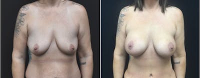 Plastic Surgery-Body Before & After Gallery - Patient 401143 - Image 1