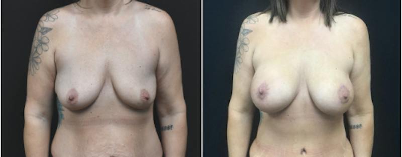 Plastic Surgery-Body Before & After Gallery - Patient 401143 - Image 1