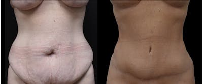 Plastic Surgery-Body Before & After Gallery - Patient 788217 - Image 1