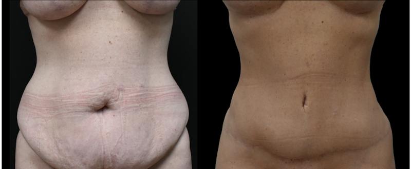 Plastic Surgery-Body Before & After Gallery - Patient 788217 - Image 1