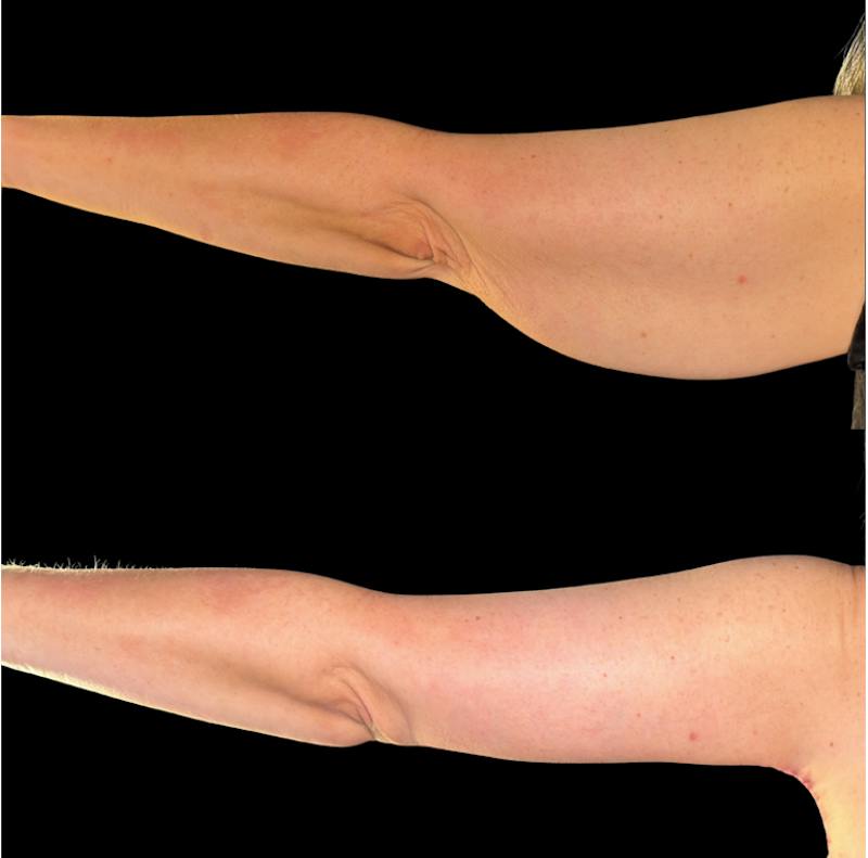 Plastic Surgery-Body Before & After Gallery - Patient 324975 - Image 1