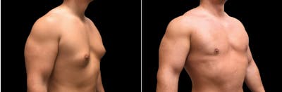 Plastic Surgery-Body Before & After Gallery - Patient 101197 - Image 1