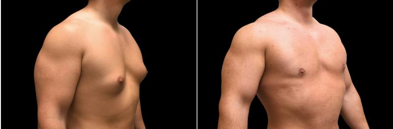 Plastic Surgery-Body Before & After Gallery - Patient 101197 - Image 1