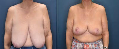 Plastic Surgery-Body Before & After Gallery - Patient 187160 - Image 1