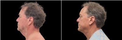 Facial Plastic Surgery Before & After Gallery - Patient 337254 - Image 1