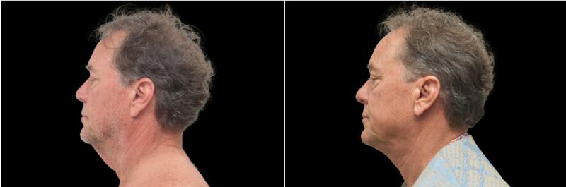 Facial Plastic Surgery Before & After Gallery - Patient 337254 - Image 1