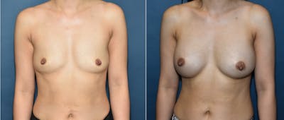 Plastic Surgery-Body Before & After Gallery - Patient 788681 - Image 1