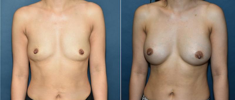 Plastic Surgery-Body Before & After Gallery - Patient 788681 - Image 1