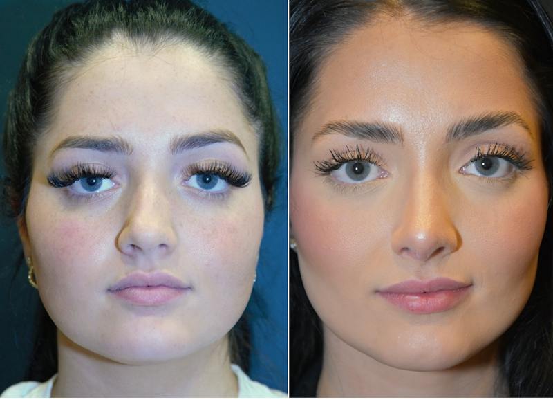 Facial Plastic Surgery Before & After Gallery - Patient 229752 - Image 1