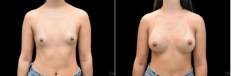 Plastic Surgery-Body Before & After Gallery - Patient 948537 - Image 1