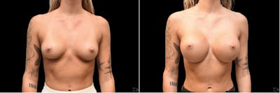 Plastic Surgery-Body Before & After Gallery - Patient 215672 - Image 1