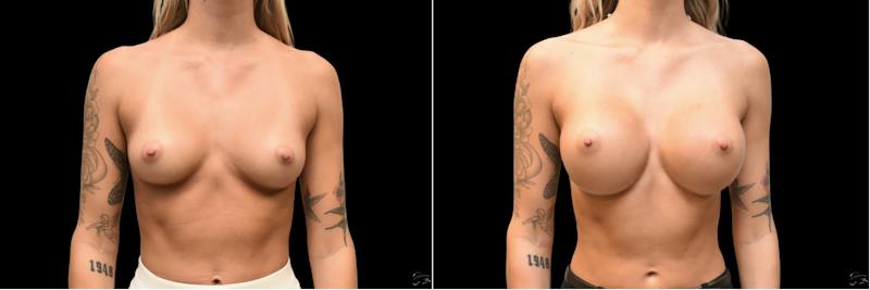 Plastic Surgery-Body Before & After Gallery - Patient 215672 - Image 1