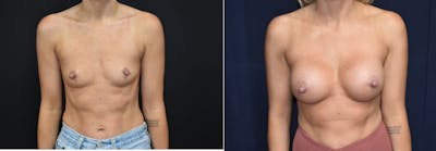 Plastic Surgery-Body Before & After Gallery - Patient 316754 - Image 1