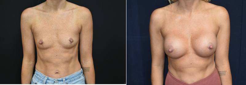 Plastic Surgery-Body Before & After Gallery - Patient 316754 - Image 1