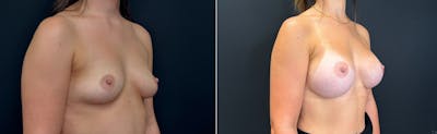 Plastic Surgery-Body Before & After Gallery - Patient 747545 - Image 1