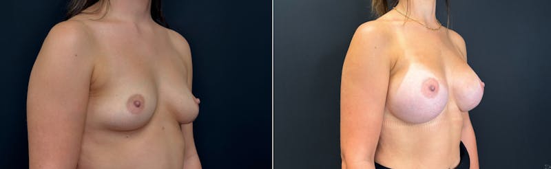 Plastic Surgery-Body Before & After Gallery - Patient 747545 - Image 1