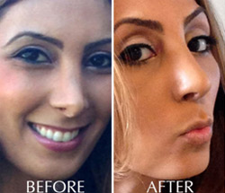 Revision Rhinoplasty Patient | California