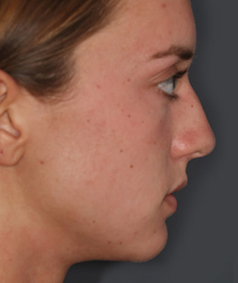 Primary Rhinoplasty Before & After Gallery - Patient 108142592 - Image 1