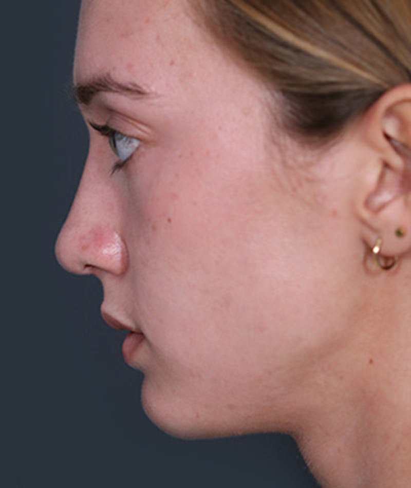 Primary Rhinoplasty Before & After Gallery - Patient 108142592 - Image 2