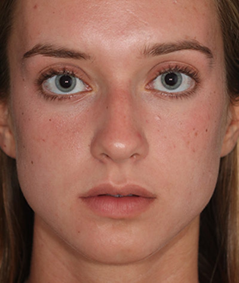 Primary Rhinoplasty Before & After Gallery - Patient 108142592 - Image 3