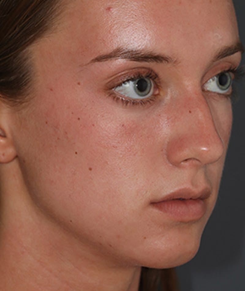Primary Rhinoplasty Before & After Gallery - Patient 108142592 - Image 5