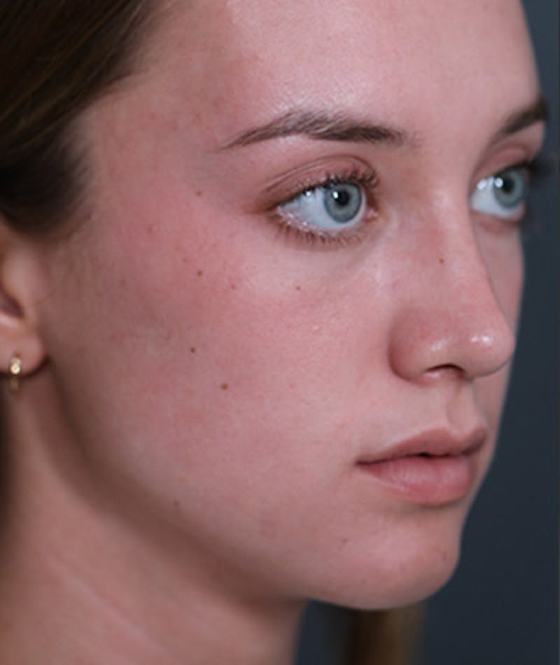Primary Rhinoplasty Before & After Gallery - Patient 108142592 - Image 6