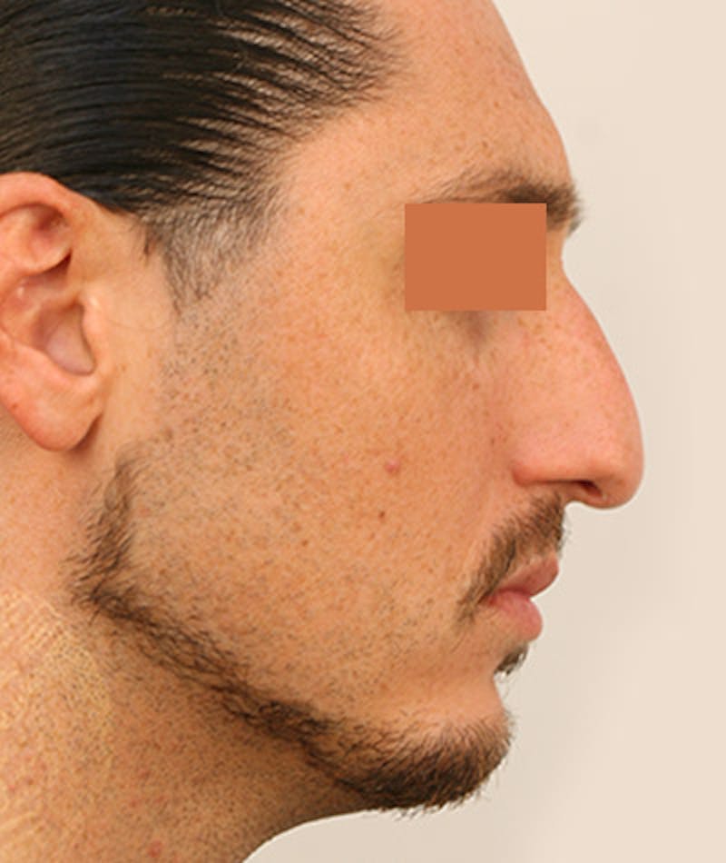Primary Rhinoplasty Before & After Gallery - Patient 108142593 - Image 1
