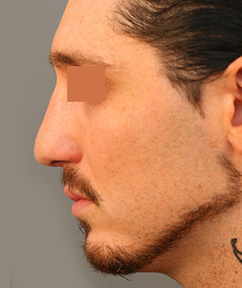 Primary Rhinoplasty Before & After Gallery - Patient 108142593 - Image 2