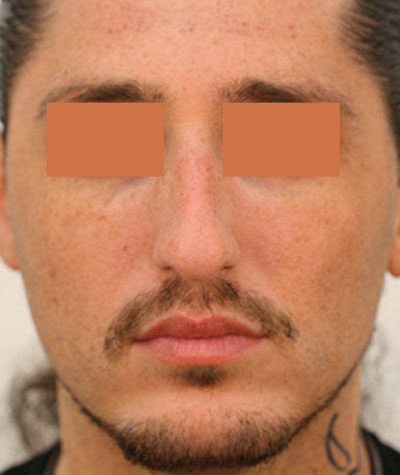 Primary Rhinoplasty Before & After Gallery - Patient 108142593 - Image 3