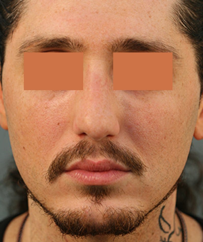 Primary Rhinoplasty Before & After Gallery - Patient 108142593 - Image 4