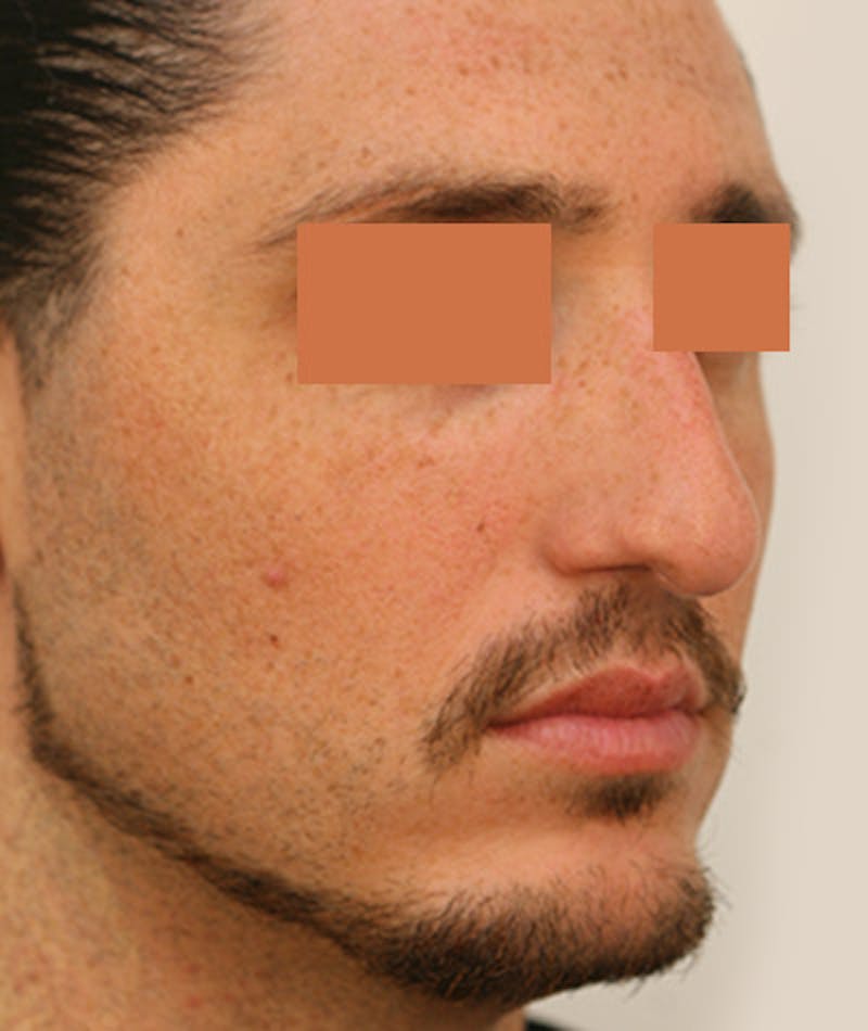 Primary Rhinoplasty Before & After Gallery - Patient 108142593 - Image 5