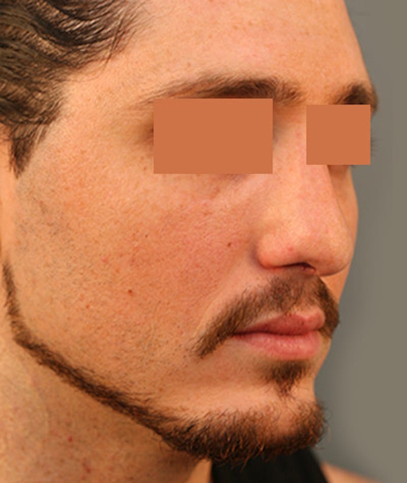 Primary Rhinoplasty Before & After Gallery - Patient 108142593 - Image 6