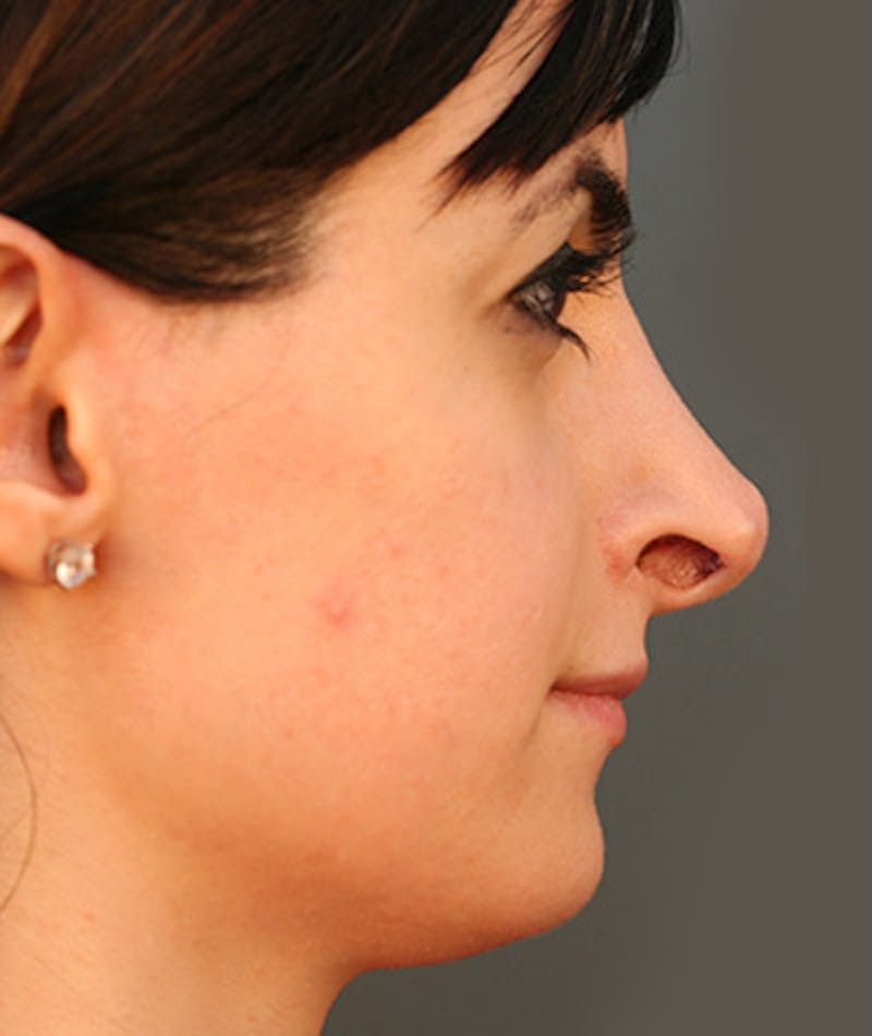 Primary Rhinoplasty Before & After Gallery - Patient 108142607 - Image 1