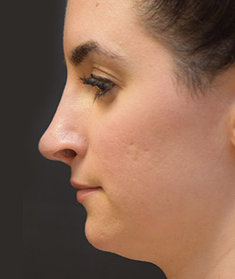 Primary Rhinoplasty Before & After Gallery - Patient 108142607 - Image 2