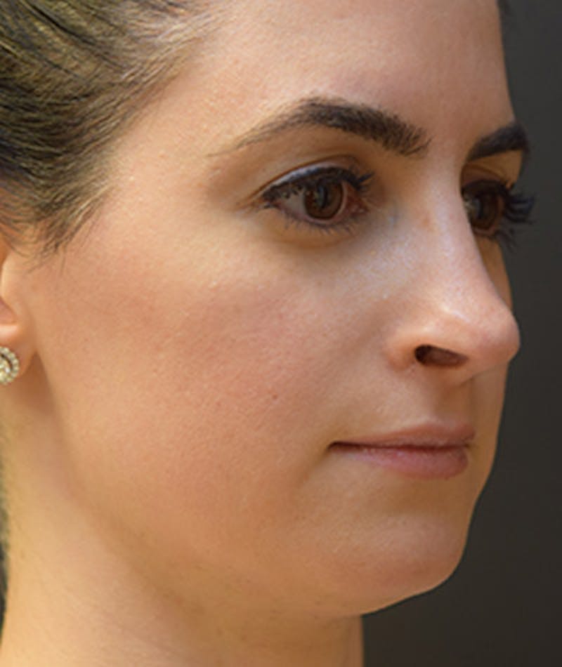 Primary Rhinoplasty Before & After Gallery - Patient 108142607 - Image 6