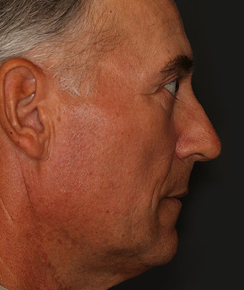 Primary Rhinoplasty Before & After Gallery - Patient 108142608 - Image 1