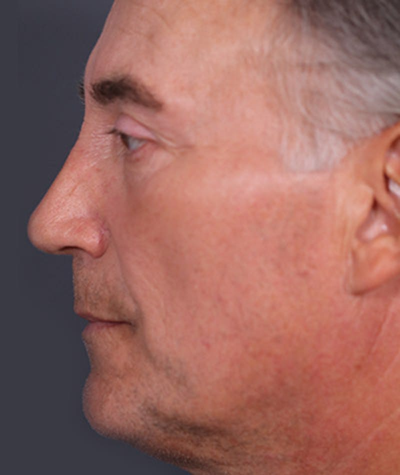 Primary Rhinoplasty Before & After Gallery - Patient 108142608 - Image 2