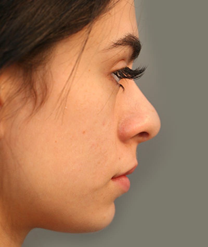 Primary Rhinoplasty Before & After Gallery - Patient 108142641 - Image 1