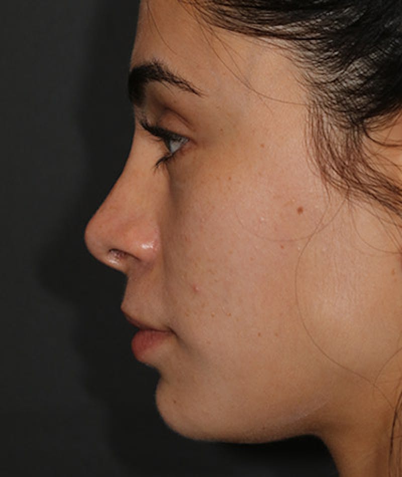 Primary Rhinoplasty Before & After Gallery - Patient 108142641 - Image 2